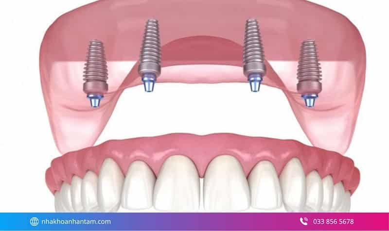 đối tượng trồng răng implant toàn hàm
