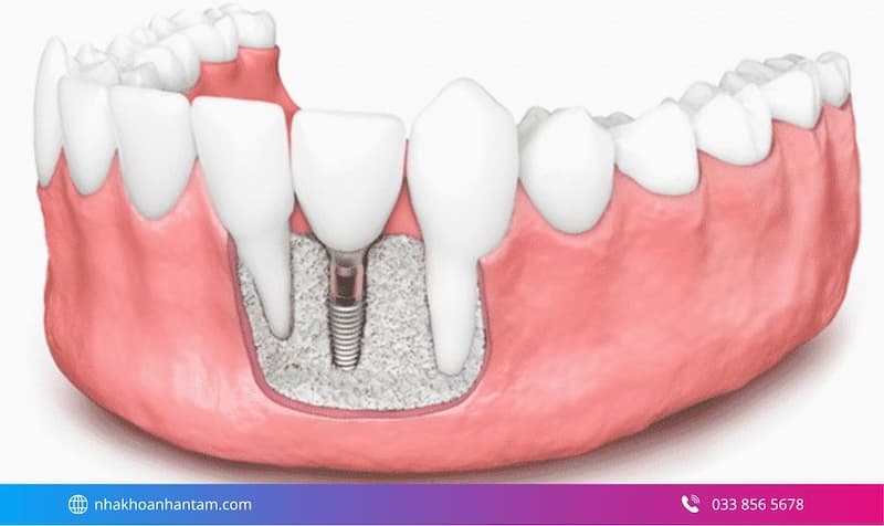 ghép xương có cần thiết không