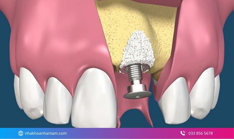 ghép xương trong cấy ghép implant