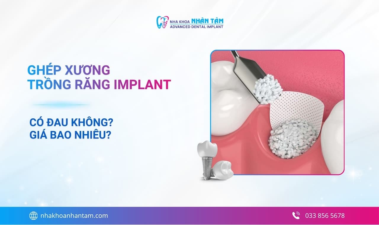 Ghép xương trồng răng Implant: Có đau không? Giá bao nhiêu? Quy trình chi tiết 2026 