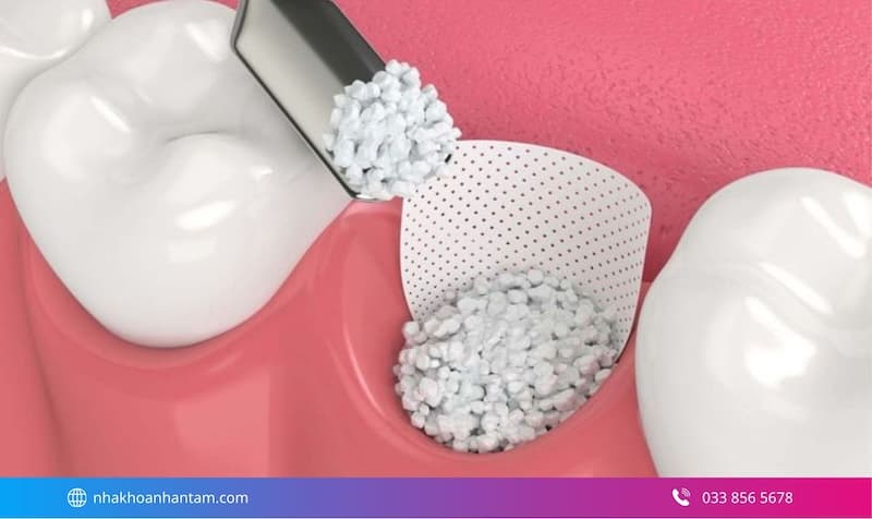 tại sao phải ghép xương khi cấy implant