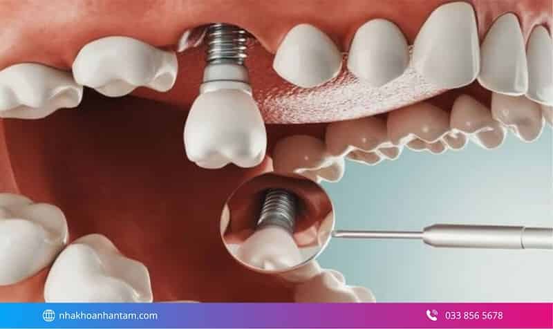 giá cấy ghép implant tức thì