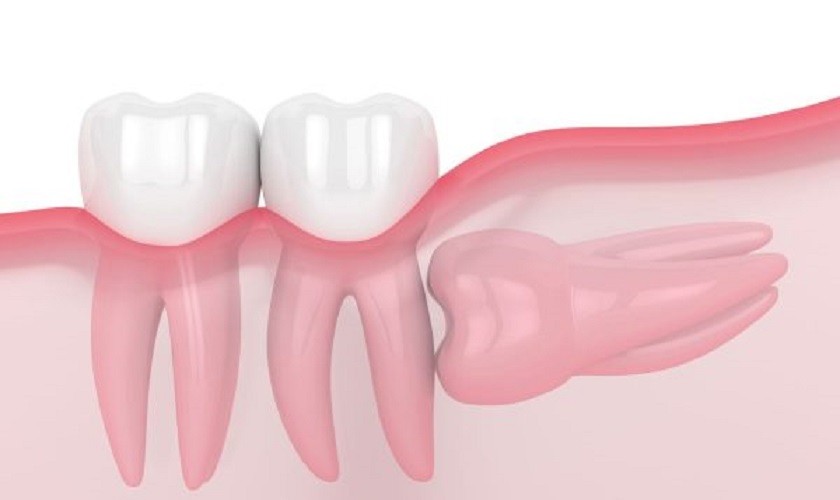 Răng khôn mọc ngầm nằm ngang trong xương hàm, đẩy vào chân răng số 7 Hình: Răng khôn mọc ngầm nằm ngang trong xương hàm, đẩy vào chân răng số 7