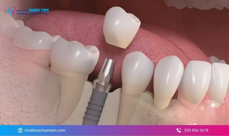 giá răng giả bao nhiêu