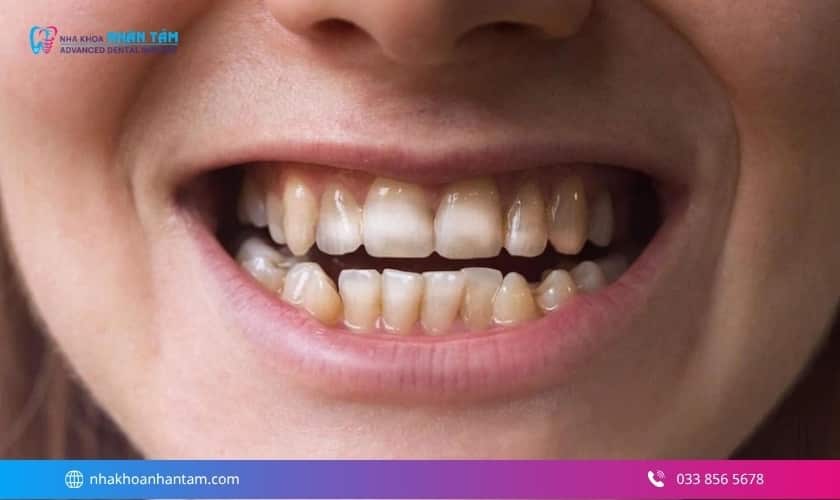 giá tẩy trắng răng