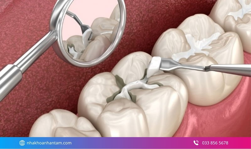 giá trám răng thẩm mỹ