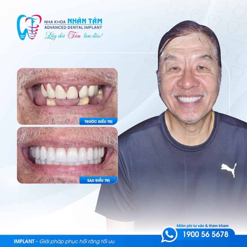 giá trồng răng implant all on 6