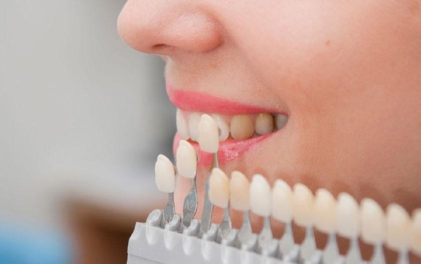 Hình: Sứ Veneer hiện là giải pháp thẩm mỹ răng được nhiều người ưa chuộng