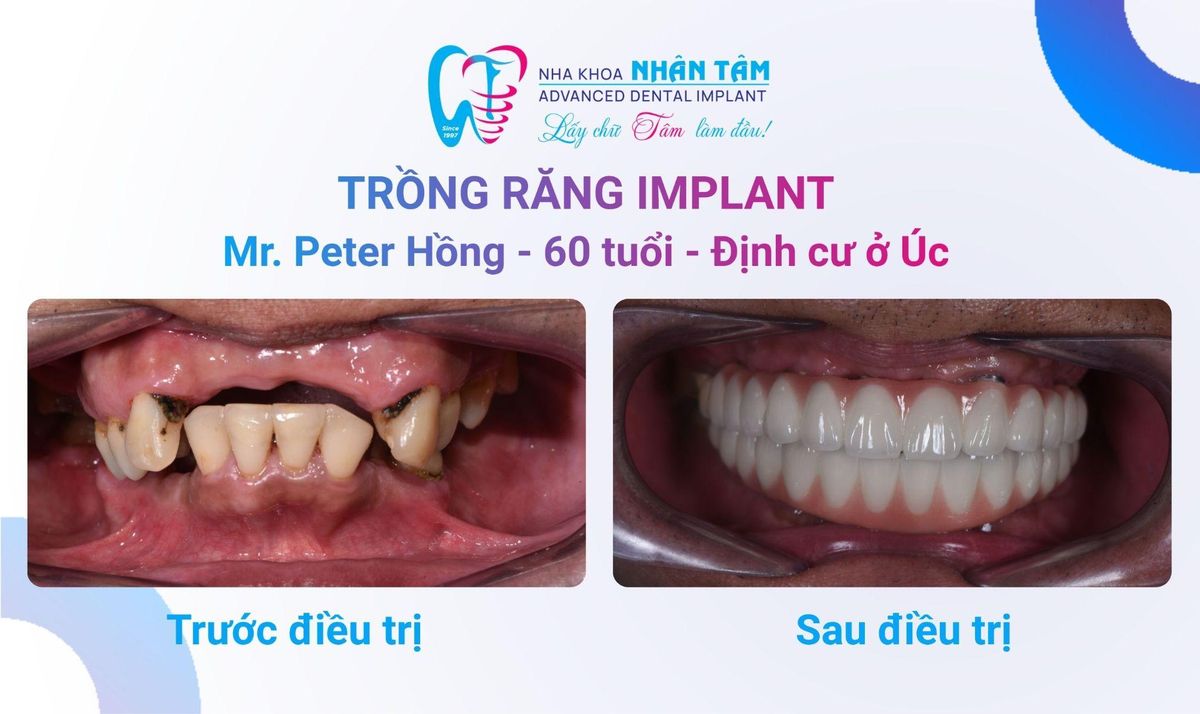 Chú Peter Hồng (Việt kiều Úc) – Câu chuyện khách hàng tại Nha khoa Nhân Tâm Hình: Chú Peter Hồng (Việt kiều Úc) – Câu chuyện khách hàng tại Nha khoa Nhân Tâm