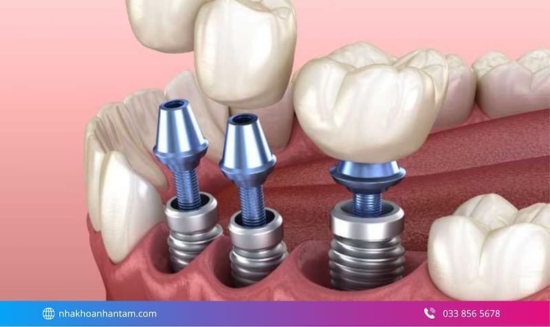 hiệu quả thực tế của implant