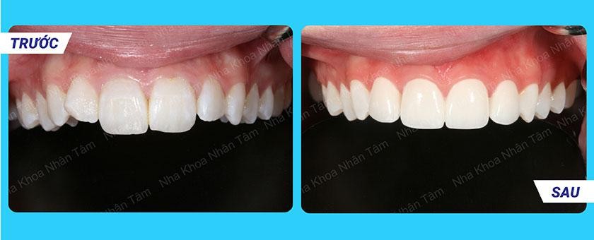 Hình: Hình ảnh trước và sau dán sứ Veneer – khách hàng 1