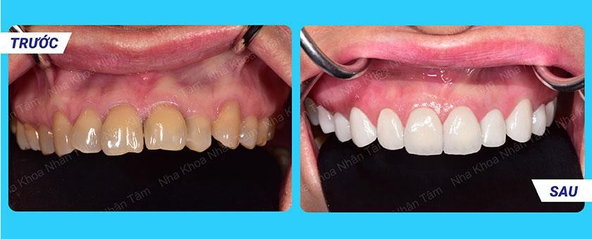 Hình: Hình ảnh trước và sau dán sứ Veneer – khách hàng 2