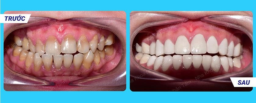 Hình: Hình ảnh trước và sau dán sứ Veneer – khách hàng 3