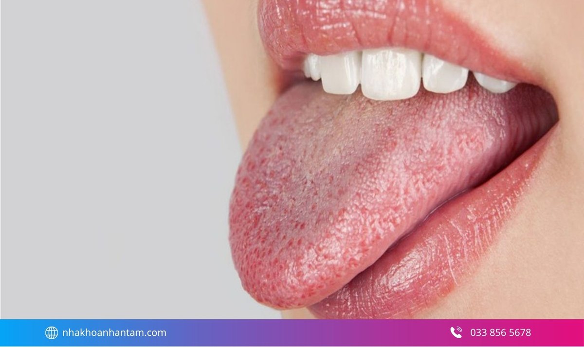 Hôi miệng có thể là do nấm lưỡi Hình: Hôi miệng có thể là do nấm lưỡi