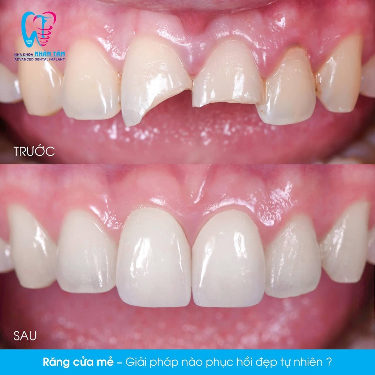 Hồi Xuân Nụ Cười Với Phương Pháp Bọc Răng Sứ Thẩm Mỹ Hồi Xuân Nụ Cười Với Phương Pháp Bọc Răng Sứ Thẩm Mỹ