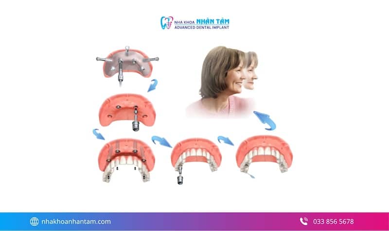 implant all on 4 có tốt không