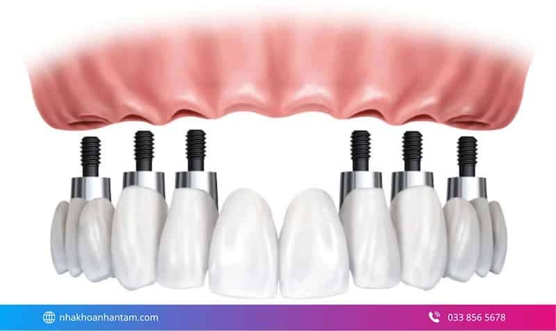 implant all on 6 là gì