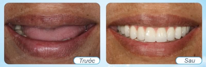 implant có phải chờ lâu không