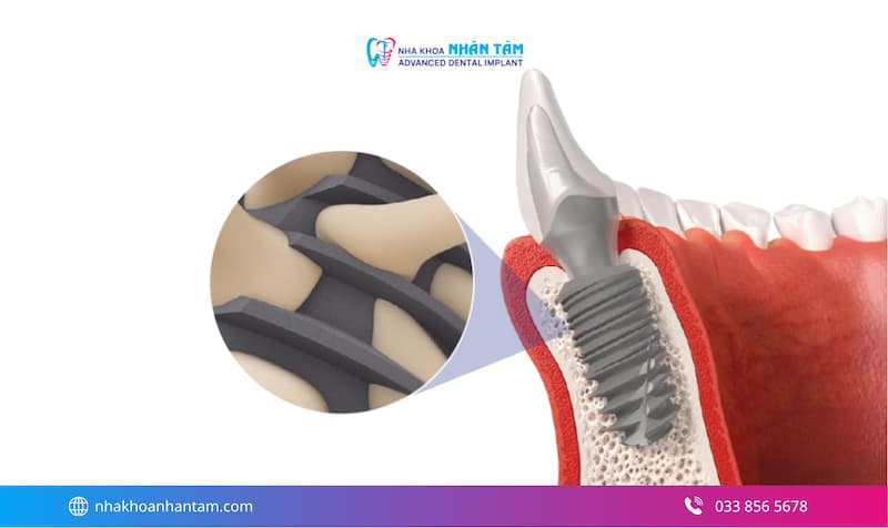 implant loại nào tốt nhất