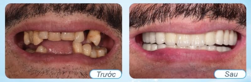 implant mất mấy tháng để hoàn thiện