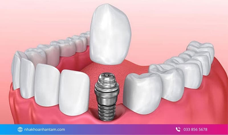 implant nobel của nước nào