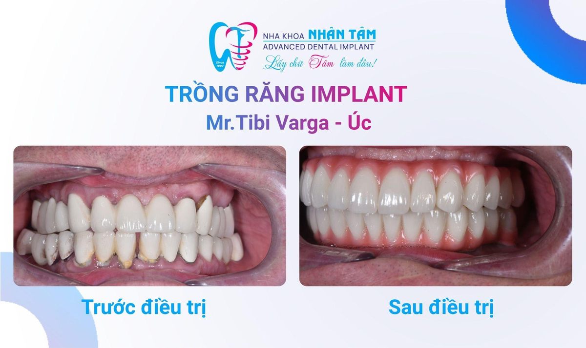 Hình: Chú Tibi Varga (Úc) – Câu chuyện khách hàng tại Nha khoa Nhân Tâm