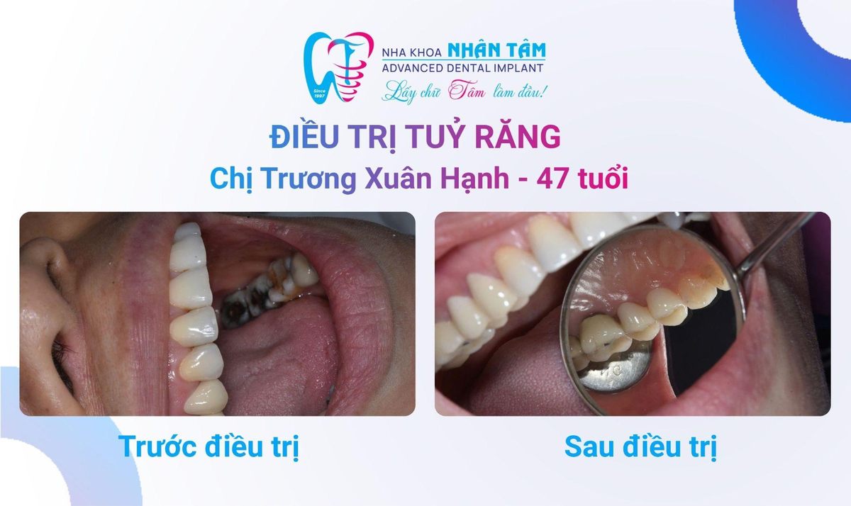 Chị Trương Xuân Hạnh – Câu chuyện khách hàng tại Nha khoa Nhân Tâm Hình: Chị Trương Xuân Hạnh – Câu chuyện khách hàng tại Nha khoa Nhân Tâm