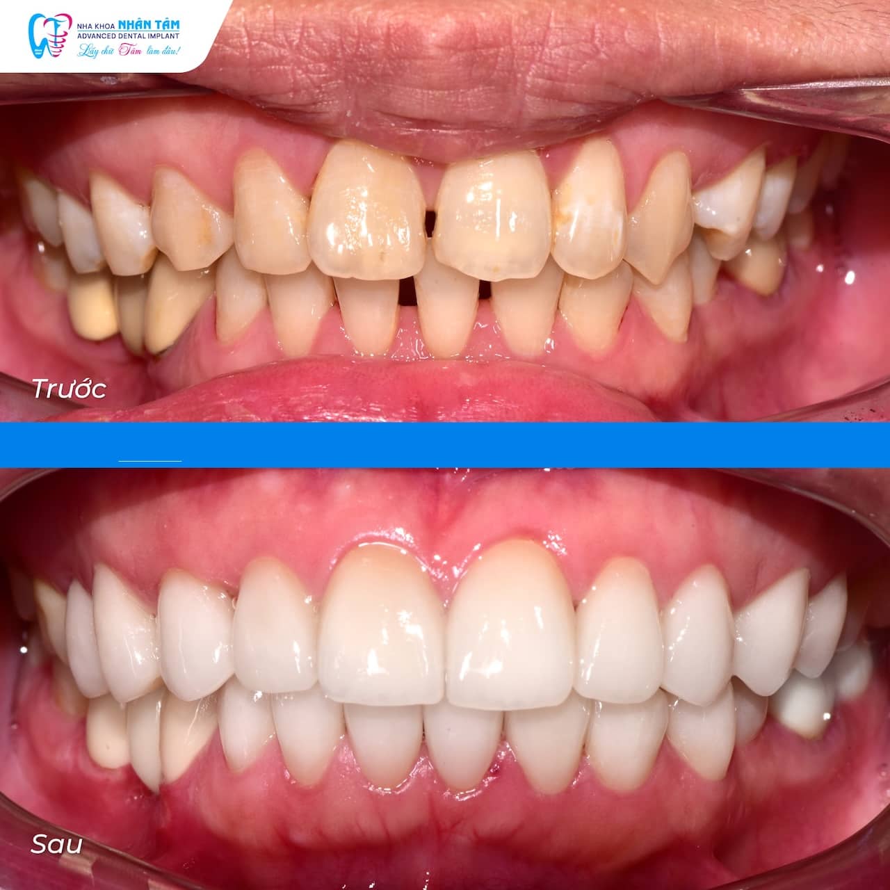 Khắc Phục Tình Trạng Răng Cánh Bướm Với Giải Pháp Răng Sứ Tự Nhiên | Nha Khoa Nhân Tâm Khắc Phục Tình Trạng Răng Cánh Bướm Với Giải Pháp Răng Sứ Tự Nhiên | Nha Khoa Nhân Tâm