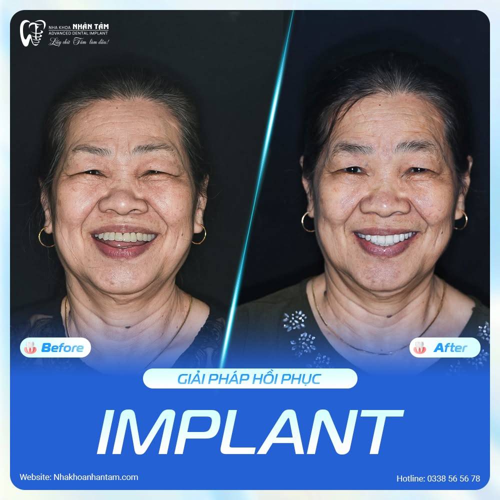 Hình: Khách hàng hài lòng khi cấy ghép implant tại Nha Khoa Nhân Tâm