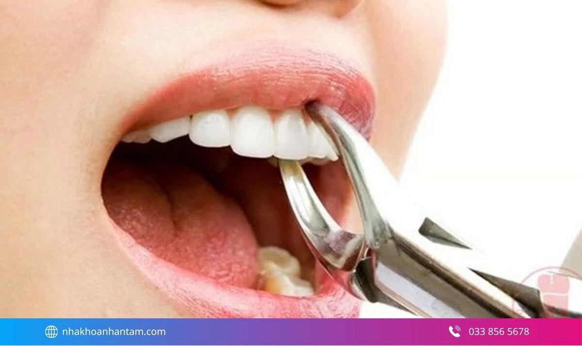 Hình: Nhổ răng cửa khi răng sâu lớn, không thể trám hoặc phục hình