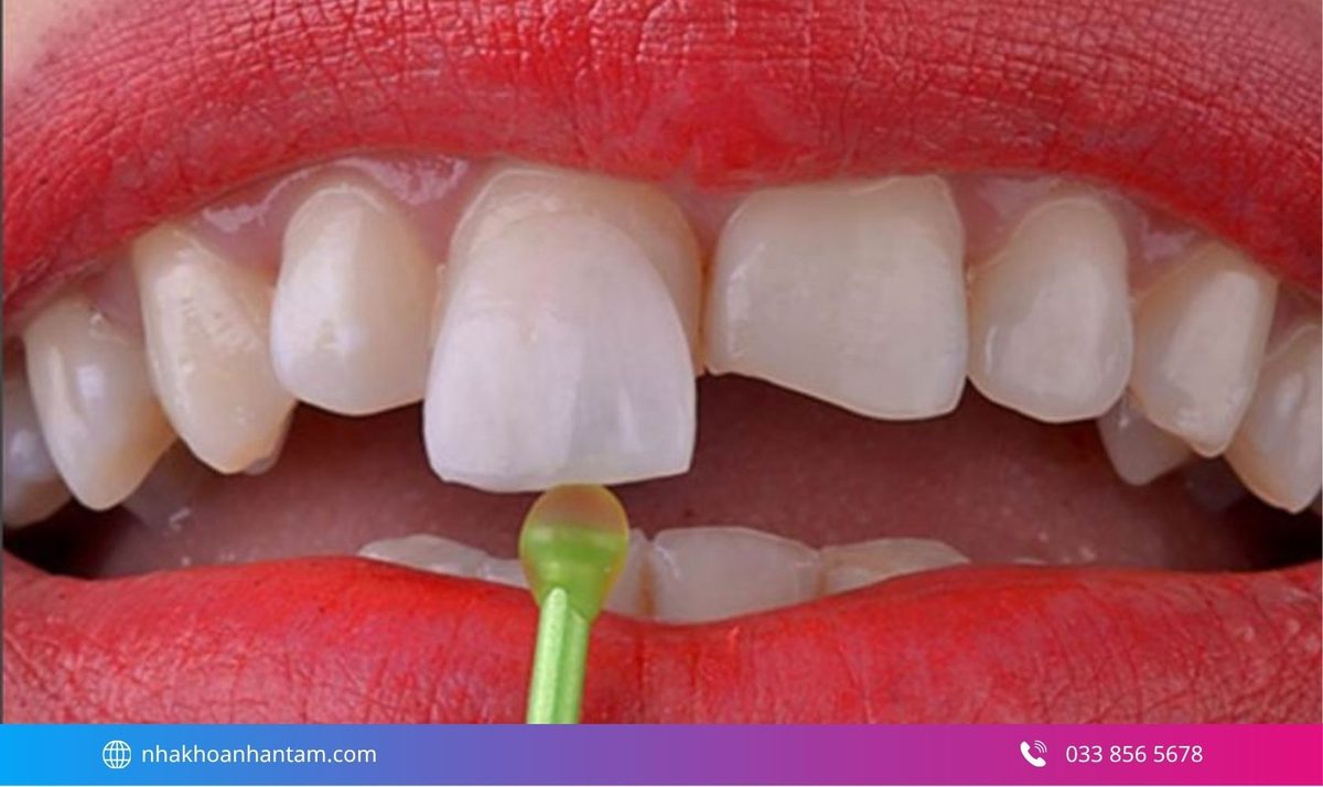 Hình: Không nên nhổ khi răng vẫn có thể phục hồi bằng trám, mão răng hoặc phương pháp khác