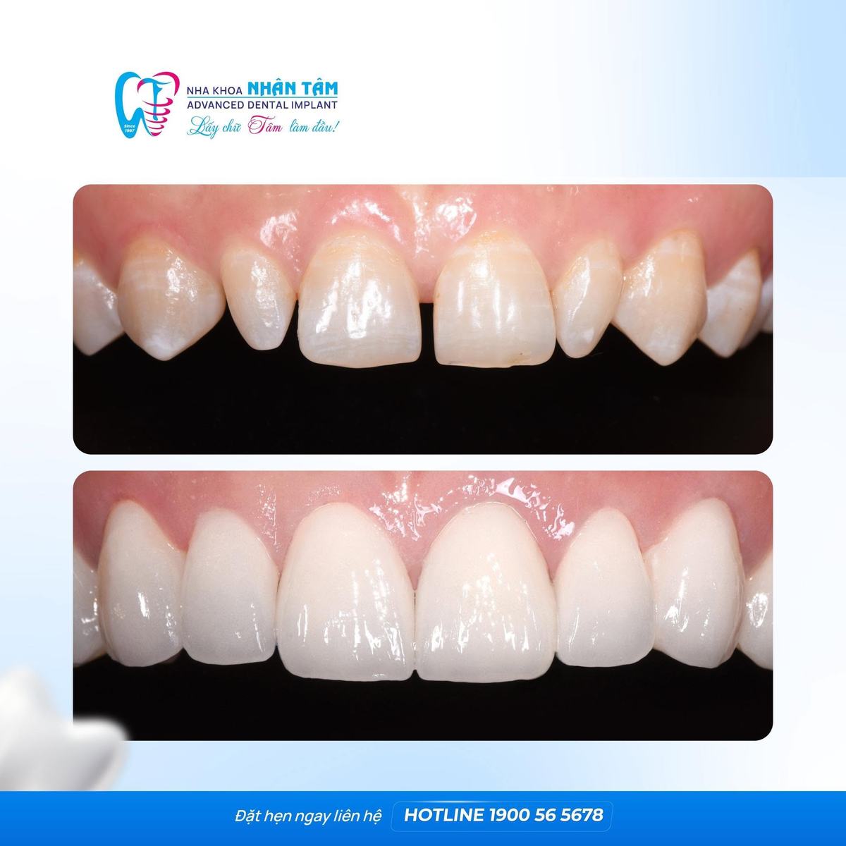 Hình: Nên bọc sứ khi muốn cải thiện hình dáng và màu sắc răng trong thời gian ngắn hơn chỉnh nha