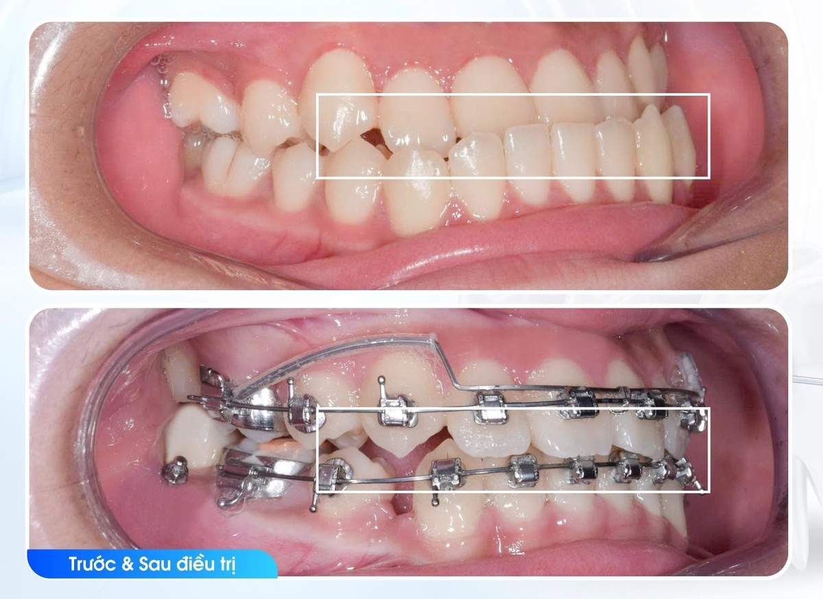 Hình: Niềng răng là giải pháp phù hợp cho tình trạng hô do răng hoặc sai lệch khớp cắn
