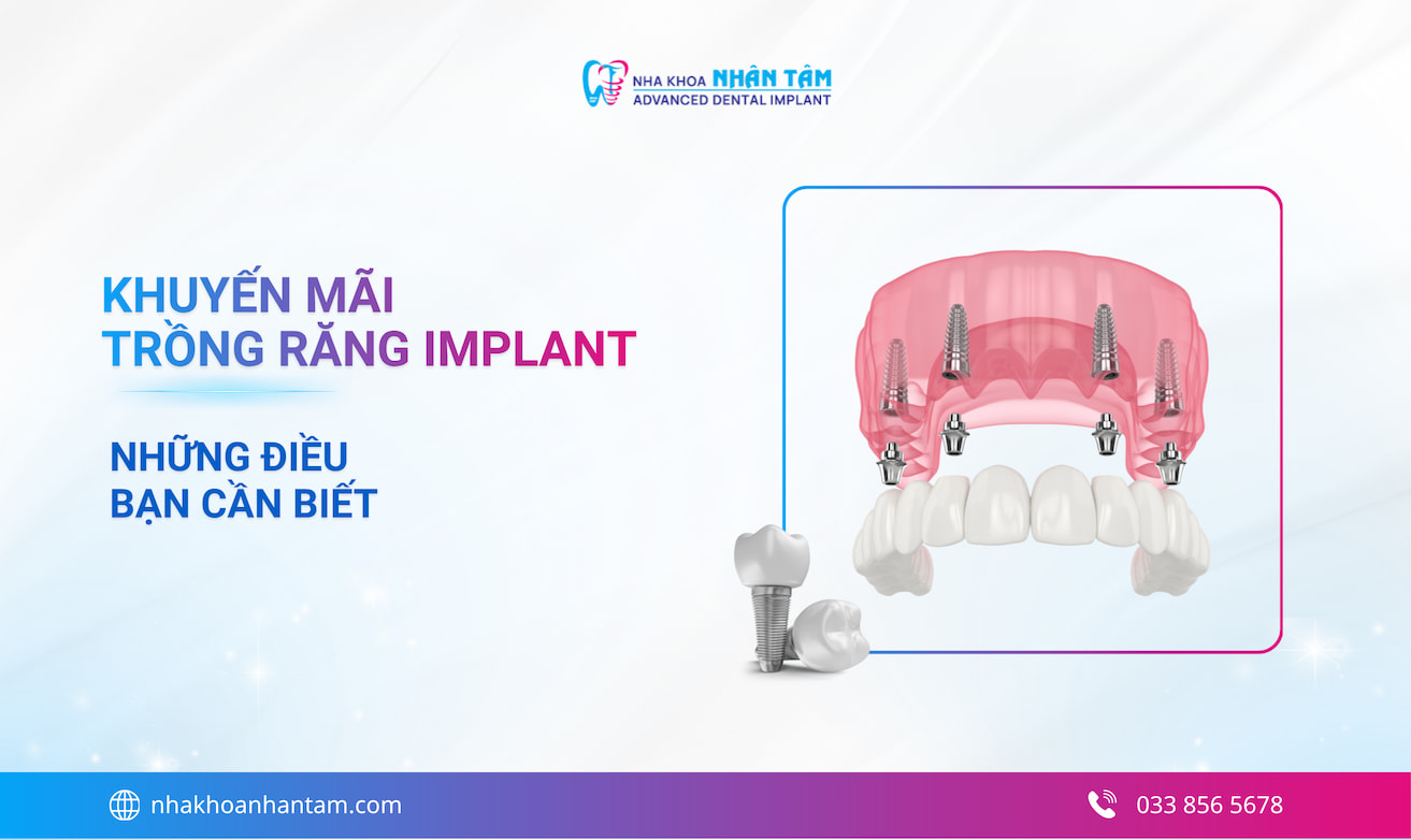 Khuyến mãi trồng răng implant và những điều cần lưu ý