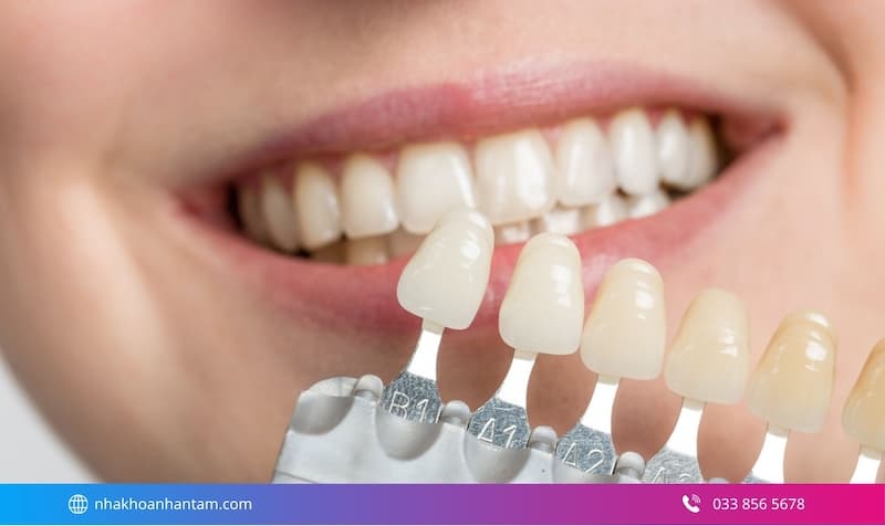 dán sứ veneer cho người mới