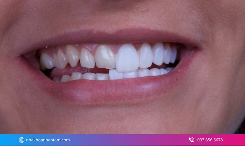 kinh nghiệm chọn veneer phù hợp