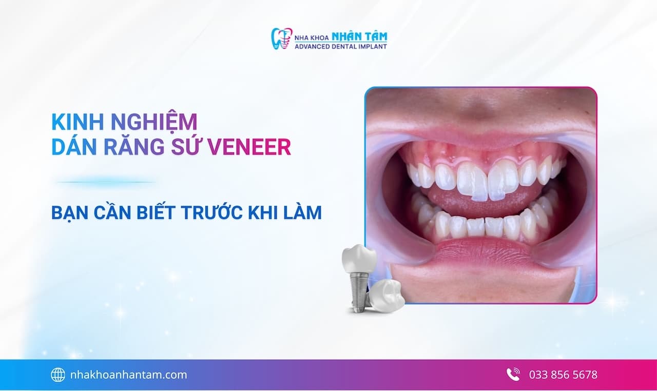 Kinh nghiệm dán răng sứ Veneer 2026: Bạn cần biết trước khi làm Hình: Kinh nghiệm dán răng sứ Veneer 2026: Bạn cần biết trước khi làm