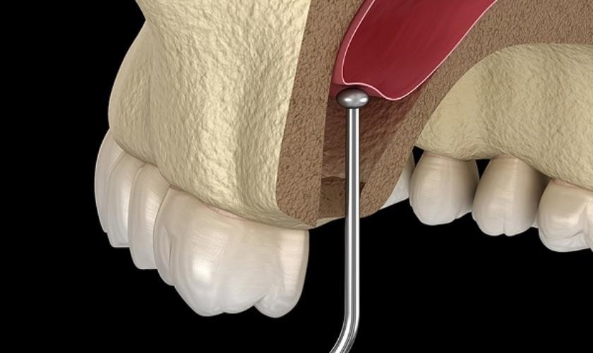 Hình: Kỹ thuật nâng xoang kín thao tác trực tiếp qua ổ cắm Implant, giúp hạn chế tối đa xâm lấn và giảm đau sưng