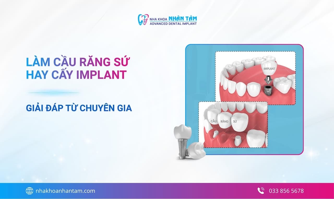 Giải đáp: Nên làm cầu răng sứ hay cấy Implant?