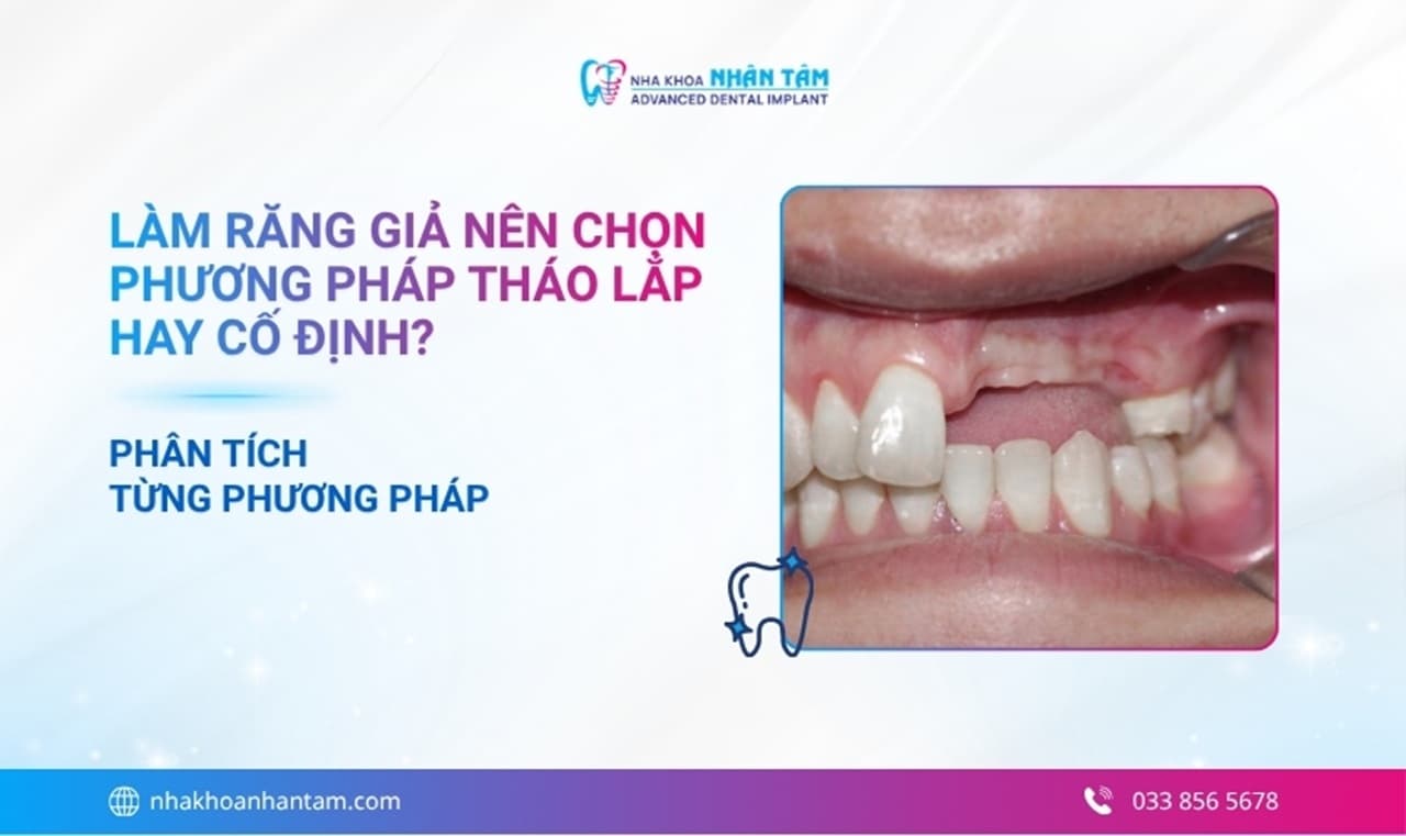 Hình: Mất răng nên làm răng giả tháo lắp hay cố định?