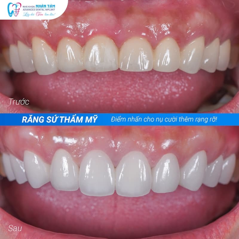 làm răng sứ trả góp