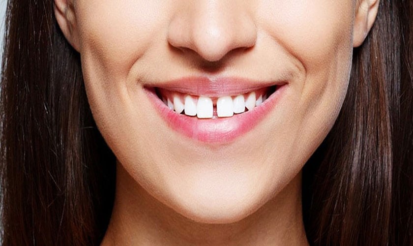 Lấy cao răng thực chất chỉ loại bỏ mảng bám vôi hóa, không gây bào mòn men răng hay làm xô lệch vị trí của răng Hình: Lấy cao răng thực chất chỉ loại bỏ mảng bám vôi hóa, không gây bào mòn men răng hay làm xô lệch vị trí của răng