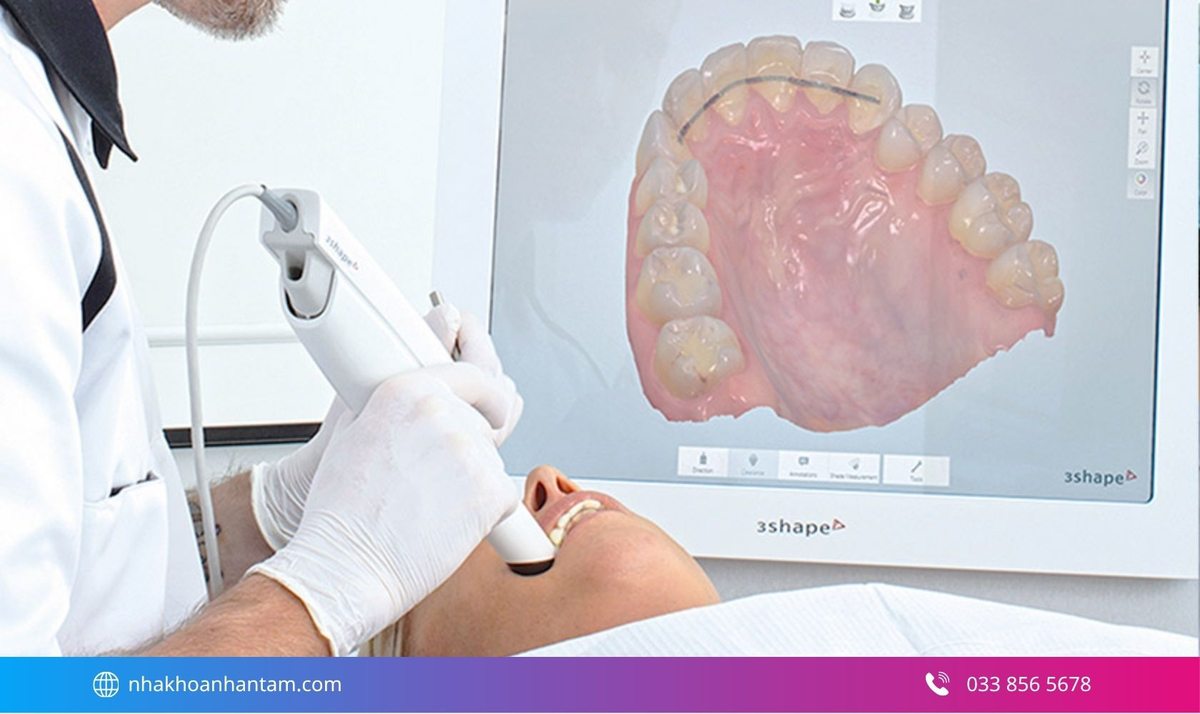 Hình: Lấy dấu răng bằng công nghệ kỹ thuật số 3Shape 3D