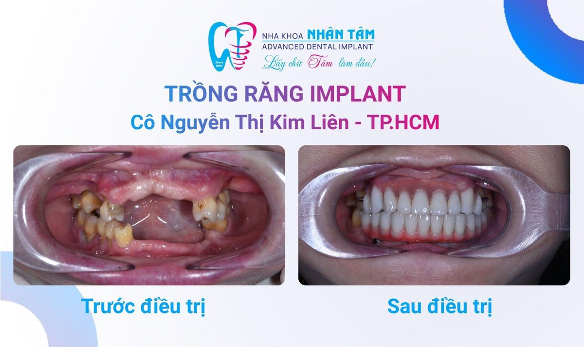 Hình: Cô Nguyễn Thị Kim Liên – Câu chuyện khách hàng tại Nha khoa Nhân Tâm