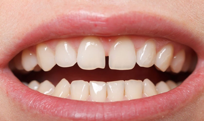 Việc loại bỏ lớp vôi răng dày tích tụ lâu ngày làm lộ ra khoảng trống tự nhiên vốn có giữa các kẽ răng Hình: Việc loại bỏ lớp vôi răng dày tích tụ lâu ngày làm lộ ra khoảng trống tự nhiên vốn có giữa các kẽ răng