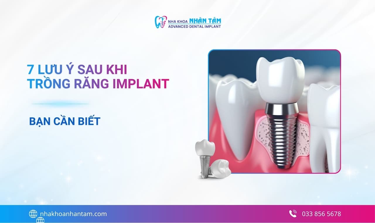 7 Lưu ý sau khi trồng răng Implant bạn cần biết