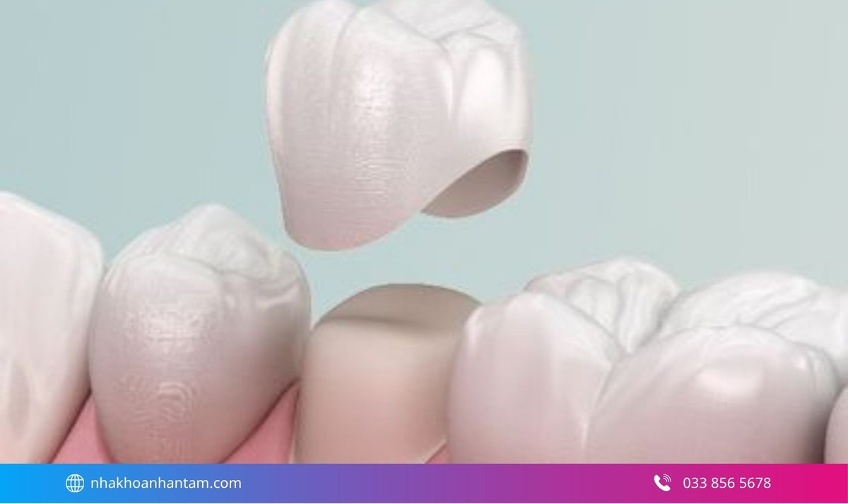 Bọc răng sứ sử dụng một mão răng được chế tác từ vật liệu sứ để bao phủ phần thân răng cần phục hồi Hình: Bọc răng sứ sử dụng một mão răng được chế tác từ vật liệu sứ để bao phủ phần thân răng cần phục hồi