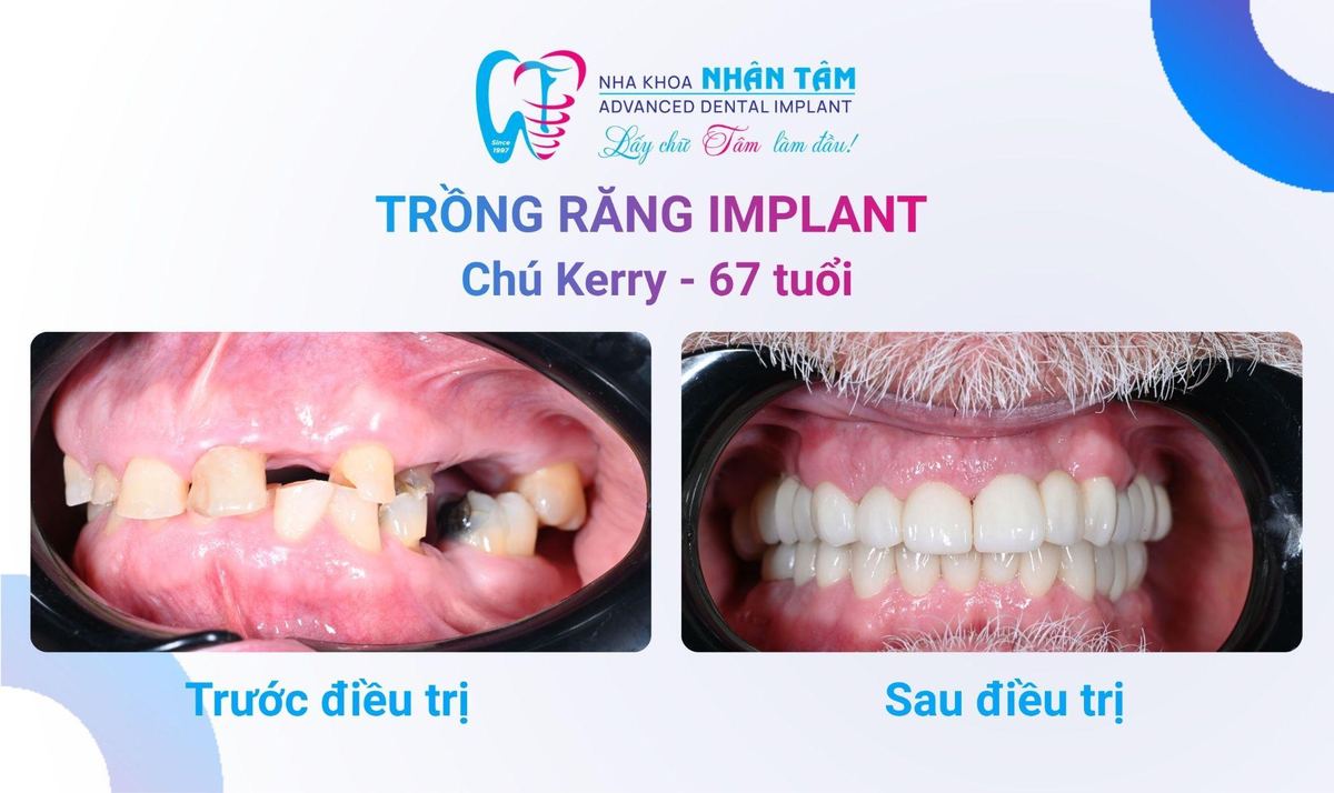 Hình: Chú Kerry – Câu chuyện khách hàng tại Nha khoa Nhân Tâm