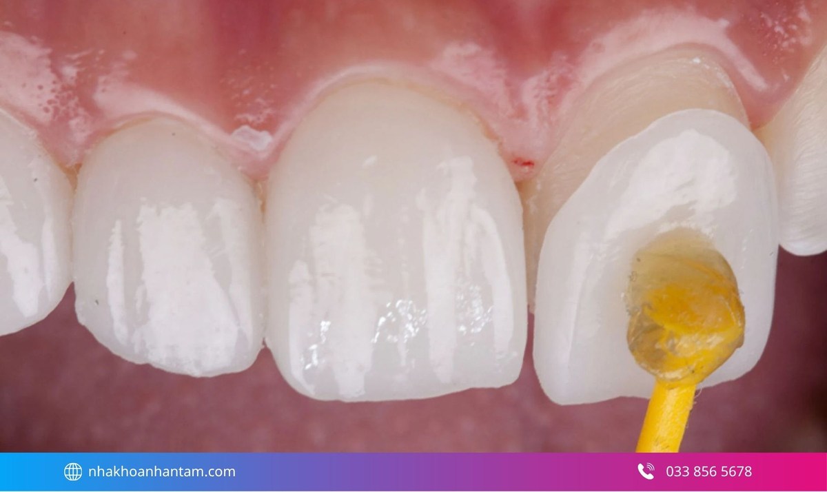 Mặt dán Veneer bị hở hoặc không khít là nguyên nhân gây hôi miệng Hình: Mặt dán Veneer bị hở hoặc không khít là nguyên nhân gây hôi miệng