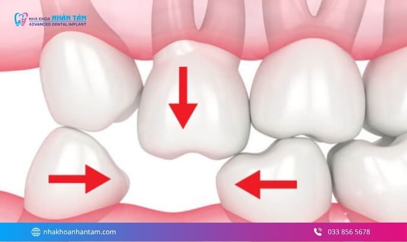 giải pháp cho người mất răng